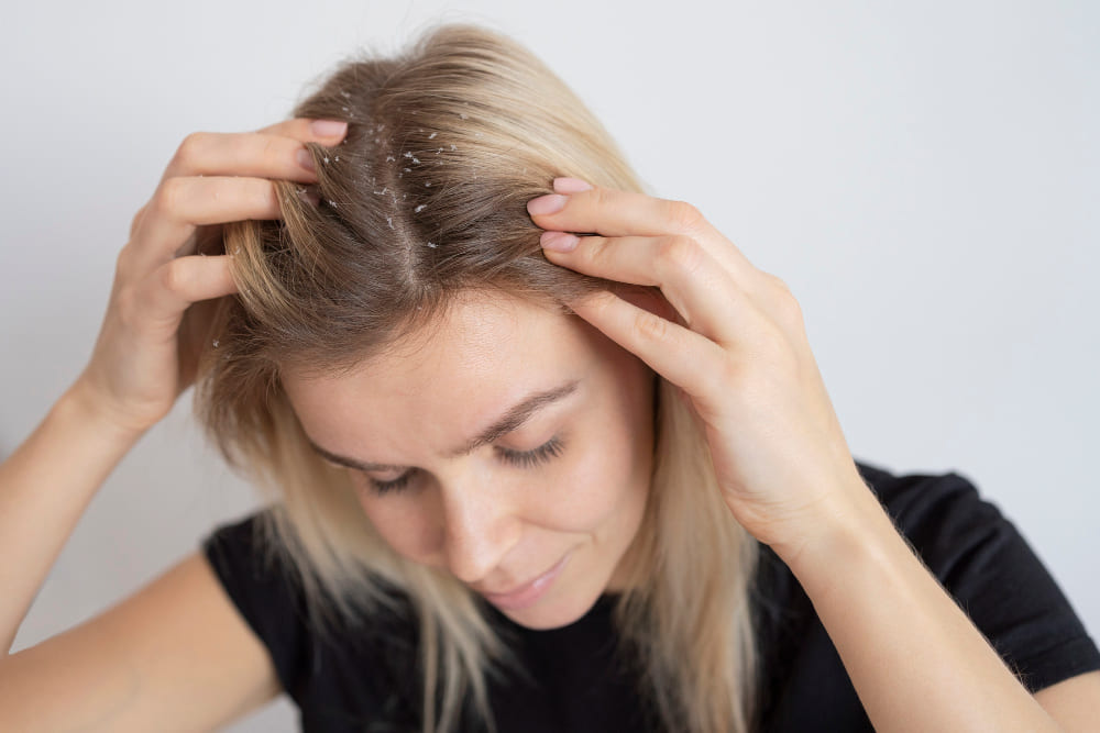 Lee más sobre el artículo Combatir la caspa y el cuero cabelludo irritado: Estrategias efectivas para un cabello saludable